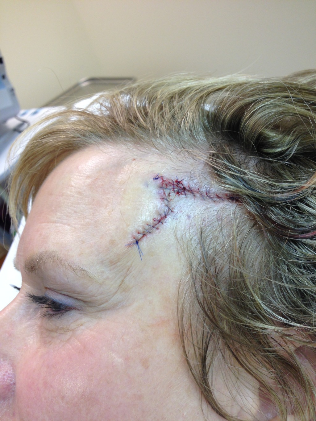 2014-03-05 11-45-24 Basal Cell Carcinoma surgery.jpg
